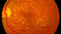 Biology seminar: Macular degeneration